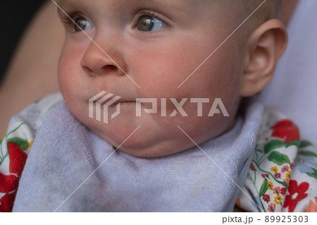 A large bump on the caucasian child chaeak. 89925303