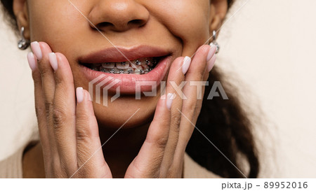 Orthodontic treatment. Teeth with braces 89952016