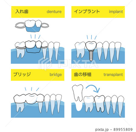 歯科インプラントと入れ歯・ブリッジの比較 89955809
