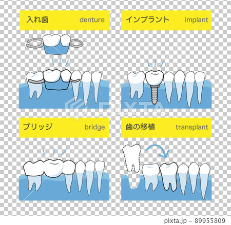 歯科インプラントと入れ歯・ブリッジの比較 89955809