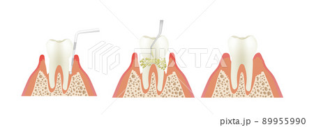 歯周病のスケーリング 歯周病のスケーリング 89955990