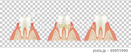 Periodontal disease scaling 89955990