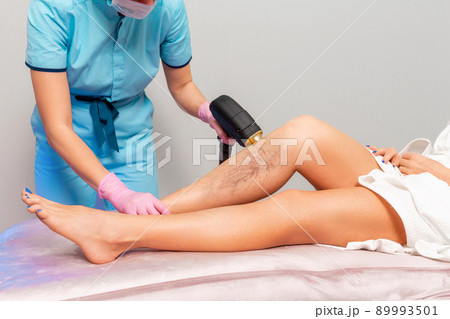 A cosmetologist does laser hair removal on woman's legs with varicose veins. Legs close-up. The concept of laser hair removal and varicose veins 89993501