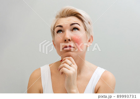 Portrait of an adult thoughtful beautiful woman with rosacea on her cheek. Gray banner. Copy space 89993731