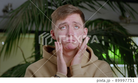 Close-up of a young man with pimples on his face. The guy is sad and pulls the skin of his face in different directions. Close-up of a young man with pimples on his face. The guy is sad and pulls the skin of his face in different directions. 89997751