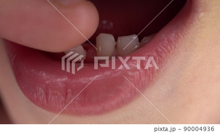 A small child has a loose milk tooth. Shaking tooth close-up. A small child has a loose milk tooth. Shaking tooth close-up. 90004936