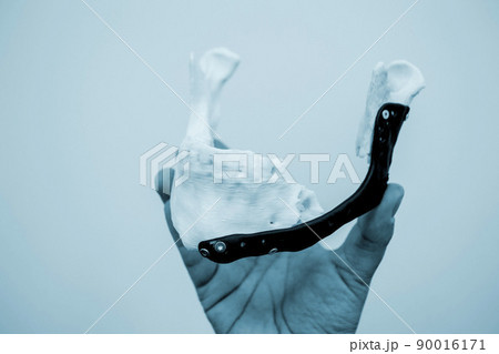 Man holding implantation of endoprosthesis of lower jaw. Model of lower jaw printed on 3D printer white plastic. Endoprosthesis printed on 3D printer for metal biocompatible titanium alloy black color 90016171