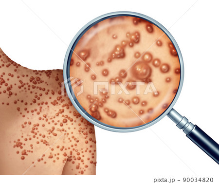 Monkeypox Virus Outbreak 90034820