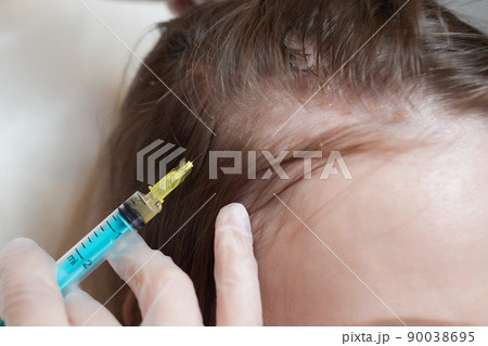 Plasma treatment, plasmolifting or PRP method point the introduction of the patient's own plasma enriched with platelets, in the problem areas of the skin. Plasma treatment, plasmolifting or PRP method point the introduction of the patient's own plasma enriched with platelets, in the problem areas of the skin. 90038695