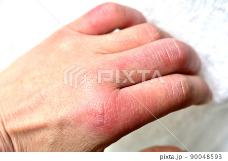 しもやけで腫れた指 しもやけで腫れた指 90048593