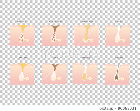 Illustration of types of pore stains Illustration of types of pore stains 90065331