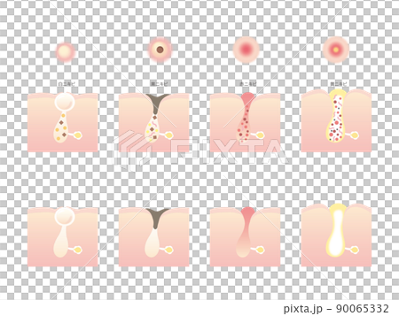 Illustrations of various acne - Stock Illustration [90065332] - PIXTA