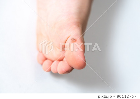 子供の足裏にできたイボ（足底疣贅・尋常性疣贅・ミルメシア） 90112757