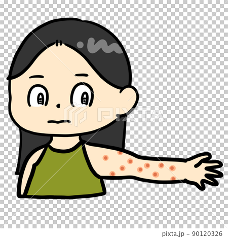 Girl with eczema on her arm - Stock Illustration [90120326] - PIXTA