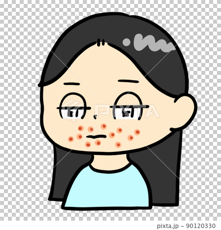 口周りに湿疹ができた子ども 口周りに湿疹ができた子ども 90120330