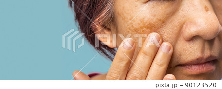 Menopausal women worry about melasma on face. Menopausal women worry about melasma on face. 90123520