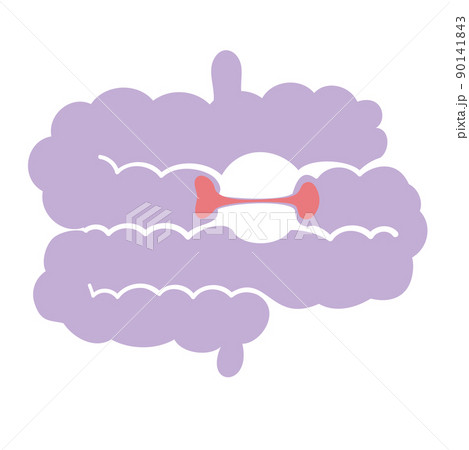 狭窄が起こっている腸 狭窄が起こっている腸 90141843