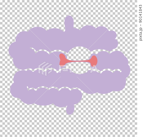 狭窄が起こっている腸 狭窄が起こっている腸 90141843