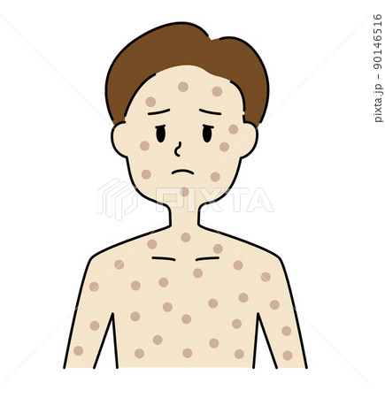 サル痘に感染し、全身リンパ節の腫れに苦しんでいる男の子 90146516
