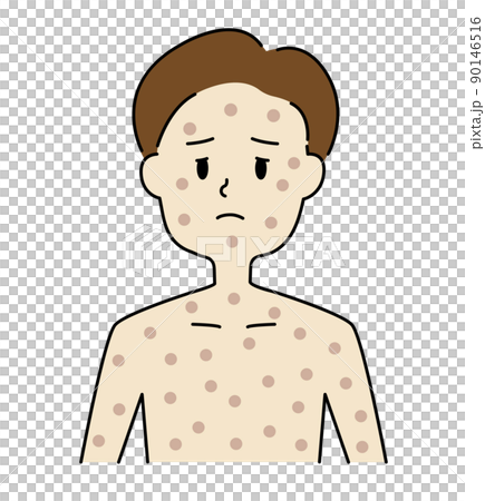 サル痘に感染し、全身リンパ節の腫れに苦しんでいる男の子 90146516