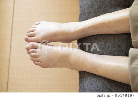 高齢者の足のむくみ 90149197