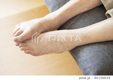 高齢者の足のむくみ 90156639