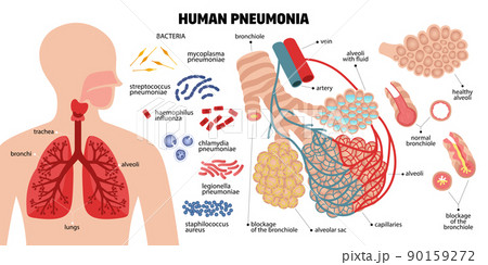 Human Pneumonia Infographic Composition 90159272