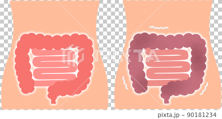 健康的腸子和不健康的腸子 90181234