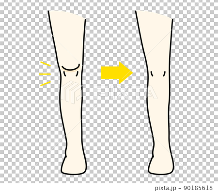 憎き膝上の肉を解消したビフォーアフターのイラスト 憎き膝上の肉を解消したビフォーアフターのイラスト 90185618