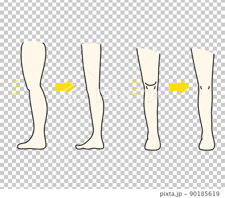 Illustration of before and after eliminating the meat on the hateful knee 90185619