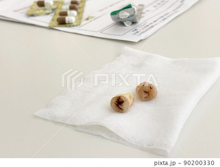 親知らずの抜歯_虫歯2 親知らずの抜歯_虫歯2 90200330