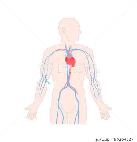 Peripherally inserted central catheter PICC on male body 90204627