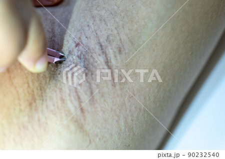 Scalp and hair follicles of human under the microscope in Lab. Scalp and hair follicles of human under the microscope in Lab. 90232540