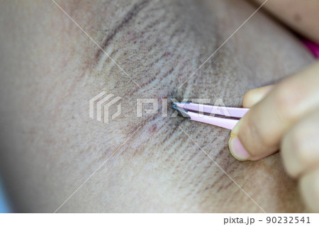 Scalp and hair follicles of human under the microscope in Lab. Scalp and hair follicles of human under the microscope in Lab. 90232541