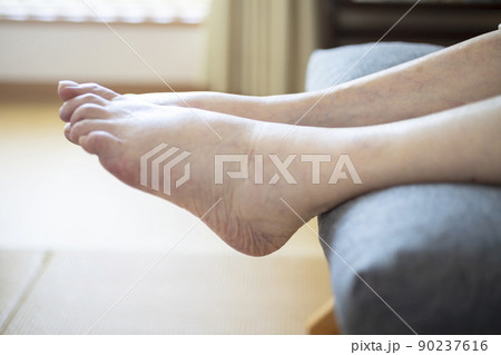 浮腫んだ高齢者の足 浮腫んだ高齢者の足 90237616