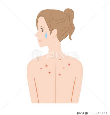 背中にニキビがある女性 背中にニキビがある女性 90242563