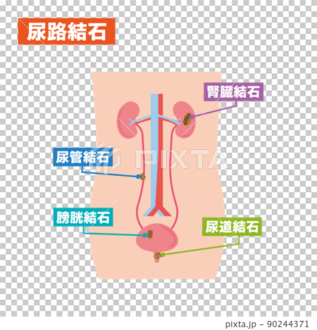 Illustrated illustration of urinary stones Illustrated illustration of urinary stones 90244371