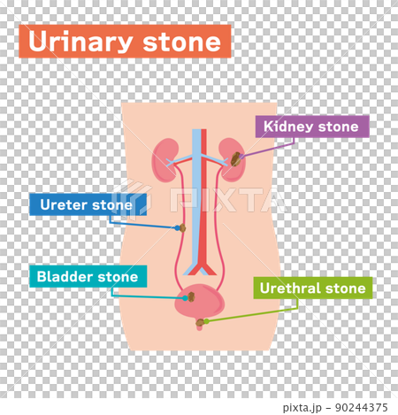 Illustrated illustration of urinary stones in English Illustrated illustration of urinary stones in English 90244375