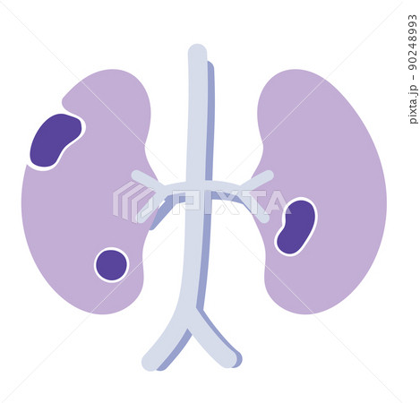 腎臓がん 90248993