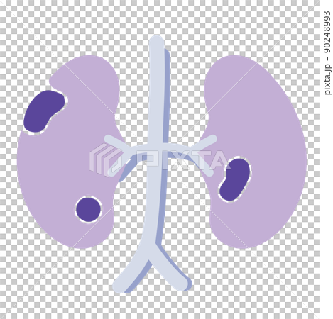 腎癌 腎癌 90248993