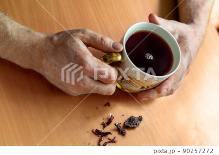 Male hands with vitiligo discoloration disease (spotty loss of skin color), holding a gilded cup of hibiscus tea. The tea leaves are on the table. 90257272
