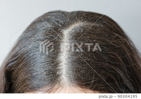 Close-up of the parting of brunette hair on the head covered with dandruff. The concept of seborrheic dermatitis 90304195