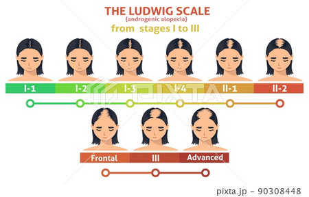 Ludwig scale of androgenic alopecia step poster 90308448