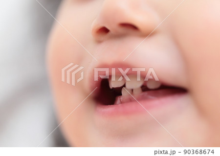 1歳の赤ちゃんに生えた乳歯 90368674
