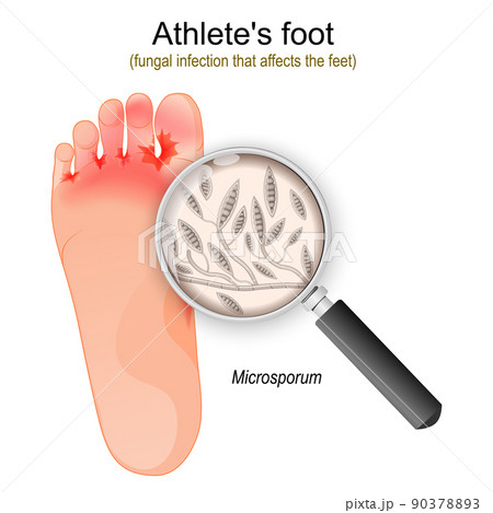 Athlete's foot. fungal infection of Microsporum 90378893