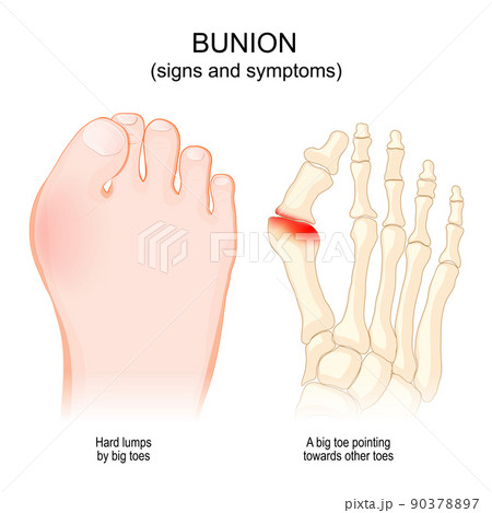 bunions. Hallux abducto valgus. bunions. Hallux abducto valgus. 90378897