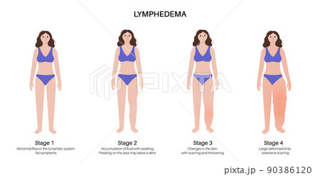 Stages of lymphedema 90386120