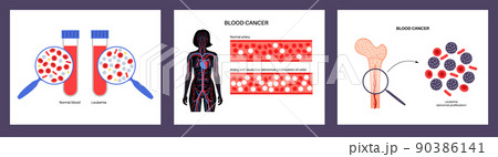 leukemia blood cancer 90386141