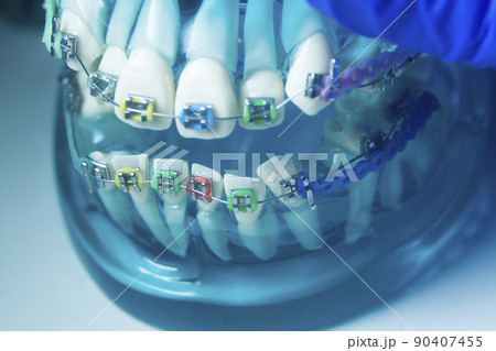 Metal teeth brackets Metal teeth brackets 90407455