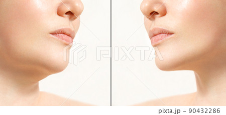 A close portrait of an aged woman before and after facial rejuvenation procedure. Correction of the chin shape liposuction of the neck. The result of the procedure in the clinic of aesthetic medicine. A close portrait of an aged woman before and after facial rejuvenation procedure. Correction of the chin shape liposuction of the neck. The result of the procedure in the clinic of aesthetic medicine. 90432286